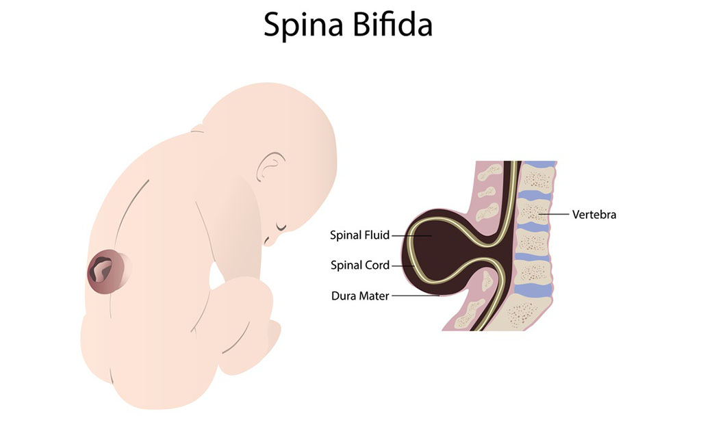 spinal bifida