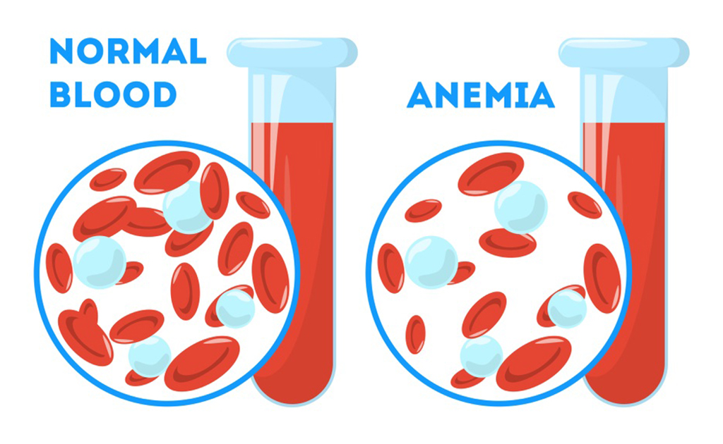 Anemia 