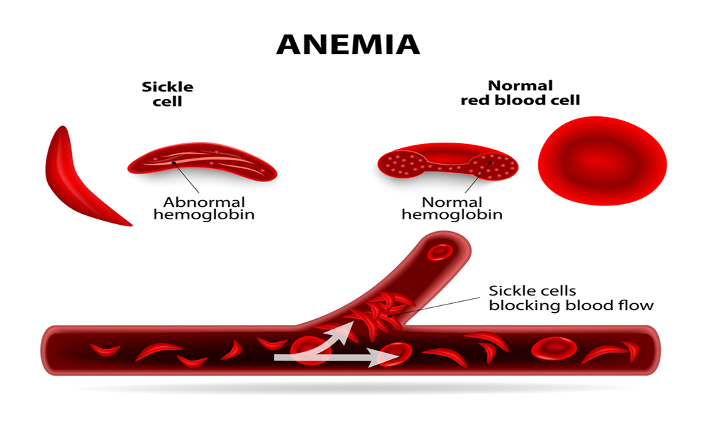 Anemia y aumento de peso