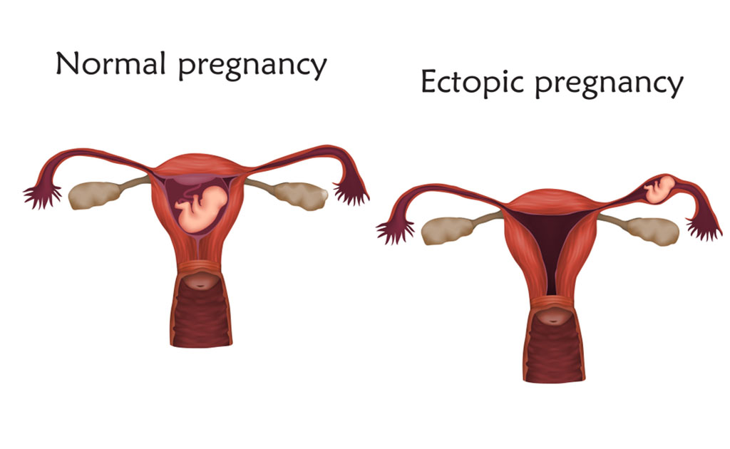 এক্টোপিক প্রেগনেন্সি