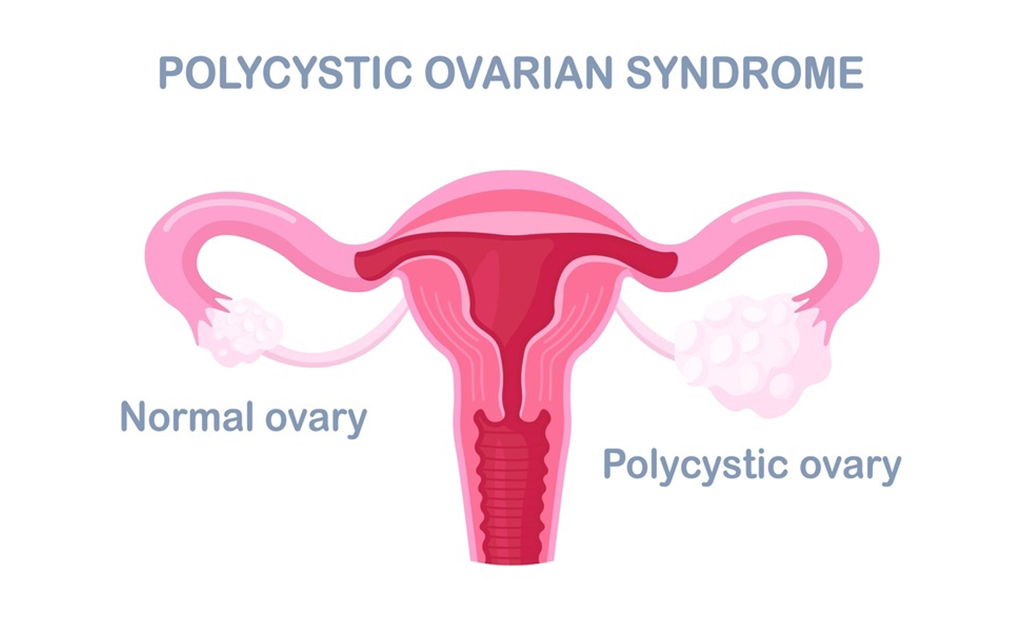 পলিসিস্টিক ওভারিয়ান সিনড্রোম 