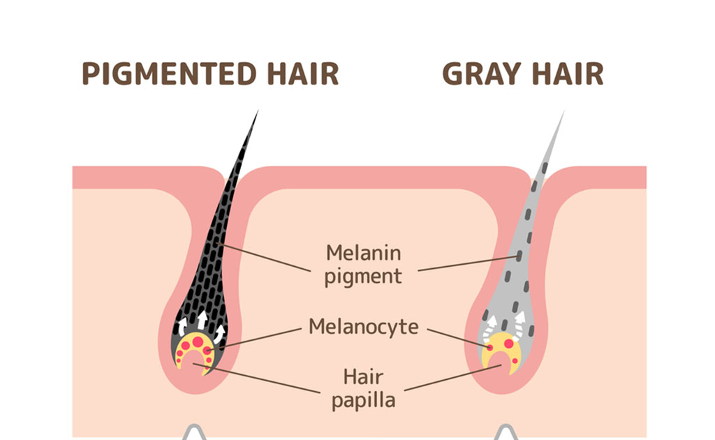 Encanecimiento prematuro del cabello