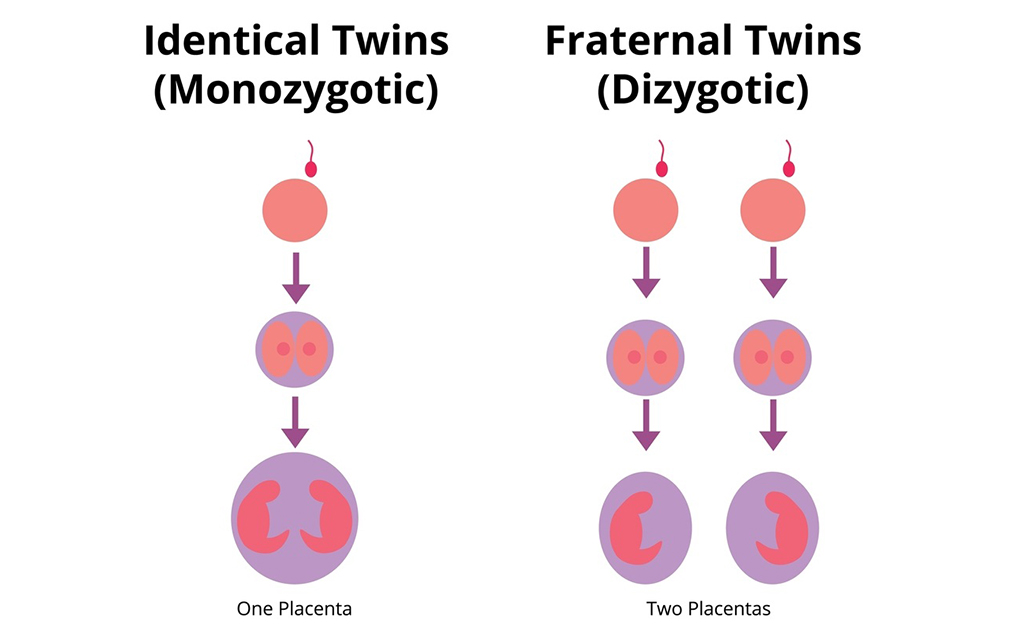 টুইন প্রেগনেন্সির প্রকারভেদ 