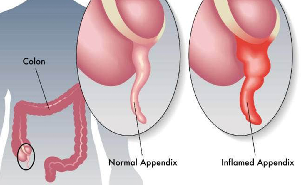 অ্যাপেন্ডিক্স এর ব্যথা হলে অ্যাপেন্ডিসাইটিস হয় 