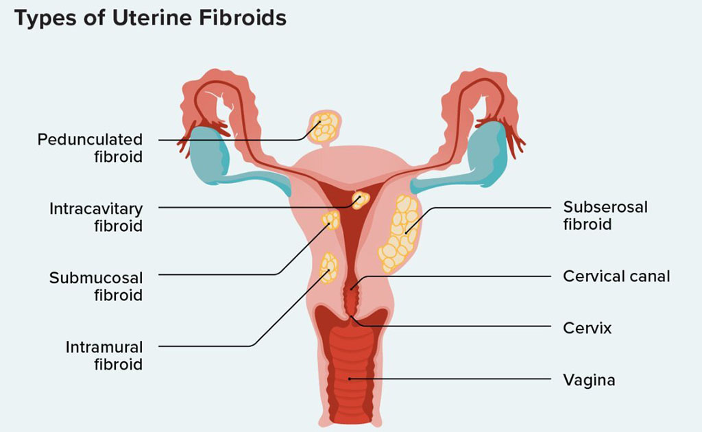 জরায়ুর ফাইব্রয়েড টিউমার এর ধরন