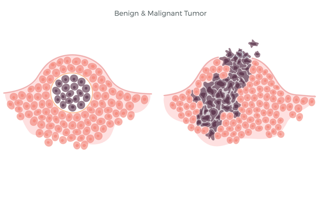 Tumor cerebral 