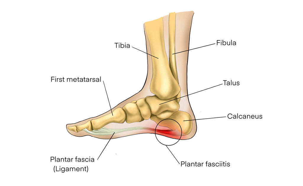পায়ের গোড়ালিতে ব্যথা বা প্লান্টার ফ্যাসাইটিস 